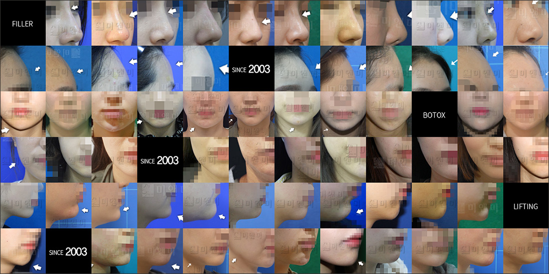 SINCE 2003 MI&MI, 시술후사진모음 천호피부과-천호역피부과 숨겨진 아름다움을 찾는 천호피부과 미앤미